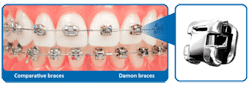 damon system braces Damon Smile braces in Bethlehem