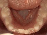 Common Orthodontic Issues