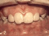 Common Orthodontic Issues