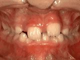 Common Orthodontic Issues