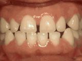 Common Orthodontic Issues